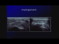 Sonography of common shoulder and elbow pathology