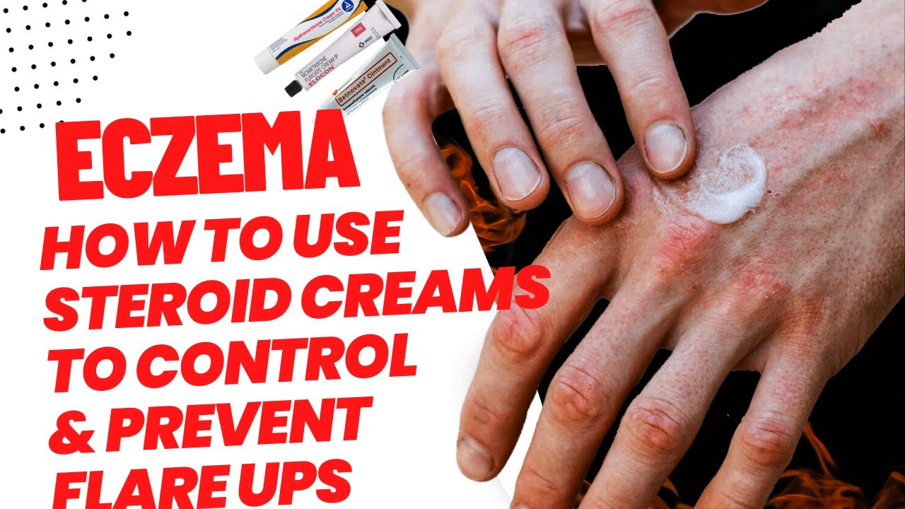 How To Treat Eczema And Prevent Flare Ups SAFELY With Steroid Creams How To Treat Eczema And Prevent Flare Ups SAFELY With Steroid Creams