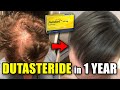 CRAZY Dutasteride Hair Loss REVERSAL In Only 1 Year