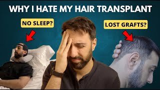 10 things I HATE about my Hair Transplant (and how I dealt with it)