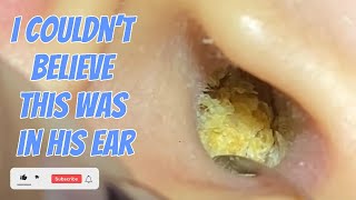 The Most Horrifying Extraction Weve Ever Filmed