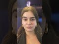 Happy patients share her inspiring journey with nose reshaping with Dr. Bashar Bizrah, Dubai/London