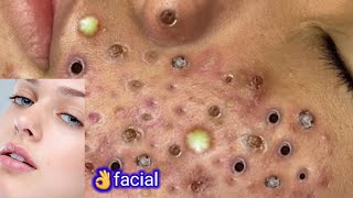 ?natural facial for removal acne,pimple,blackheads,whitehead,wrinkle at home|get fair and clear skin