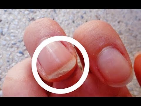 Waarom schilferen nagels? Oorzaken, behandelingen en oplossingen
