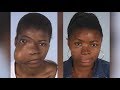 Maxillofacial Surgery: Changing Faces, Changing Lives- Kadiatu's Story