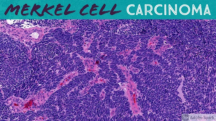Merkel Cell Carcinoma (weird palisading spindle ce...