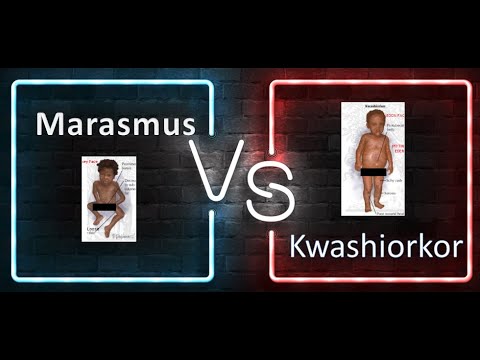 Video: Kwashiorkor Und Marasmus: Was Ist Der Unterschied?