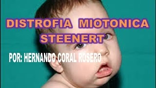 Diabetes distrofia y muscular miotónica