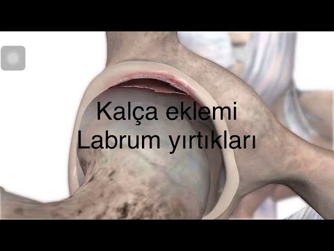 labrum yırtıkları