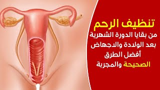 تنظيف الرحم من بقايا الدورة الشهرية وبعد الولادة والاجهاض / أفضل الطرق الصحيحة والمجربة