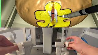 Vessel energy dissection: Robot100% DaVinci surgery series