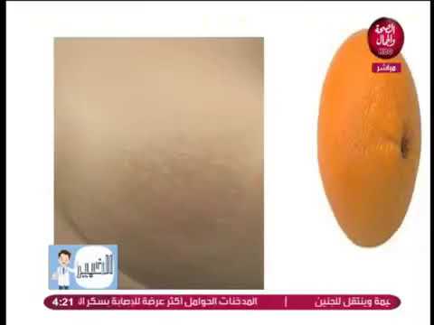 اعراض سرطان الثدي واهمية الاكتشاف المبكر...