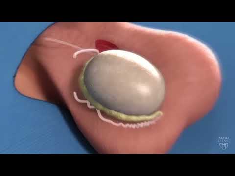 Epididymovasostomy Mayo Clinic