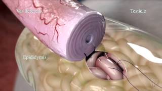 Vasectomy reversal - Mayo Clinic