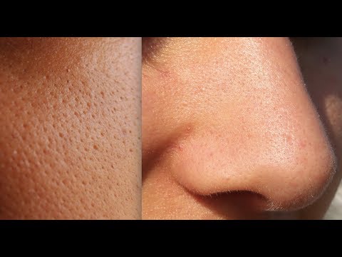 How I Shrank My Pores (How To Shrink Pores And Best Products To Remove Blackheads On Nose)
