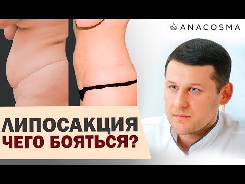 Липосакция ❗️❗️❗️ОСЛОЖНЕНИЯ❗️❗️❗️Как можно похудеть и чего бояться❗️❗️ Миронов Андрей Борисович