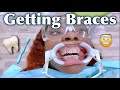 VLOG | GETTING BRACES FOR THE 1ST TIME | BRACES KIT + COOKING + LYMPHATIC MASSAGE + FAMILY REACTION