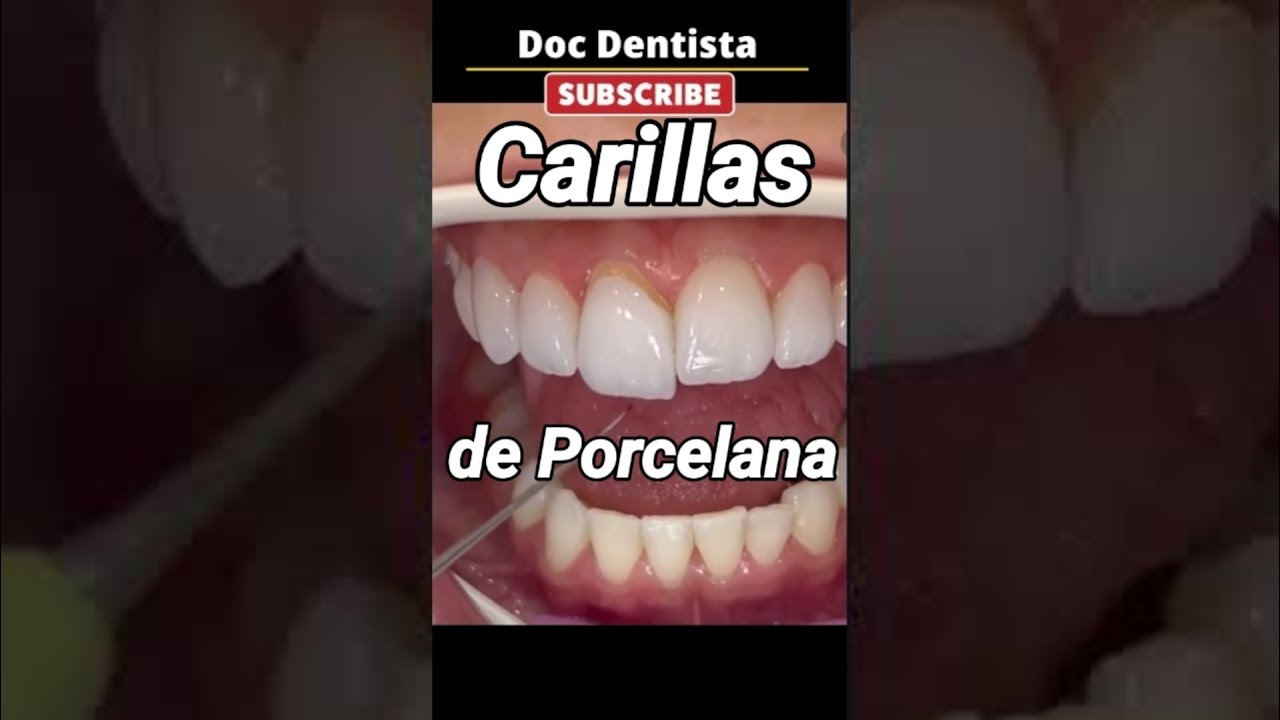 Cuanto cuestan las carillas de porcelana