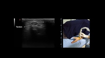 Ultrasound guided De Quervain