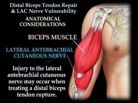 Video: Torn Bicep Injury: Soorten, Oorzaken, Symptomen En Behandeling