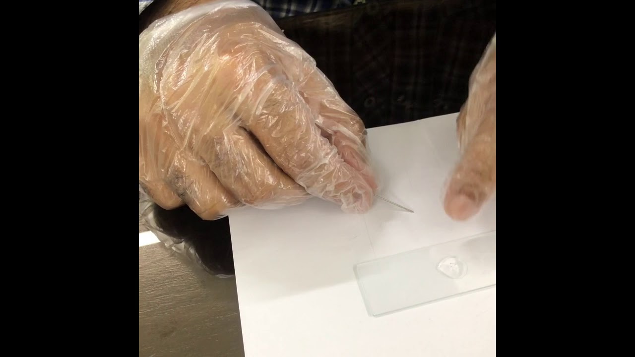 Scabies Mite Extraction Youtube