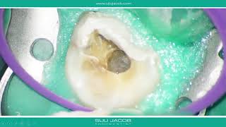 Calcified maxillary second molar