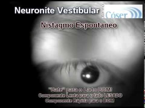 "Labirintite": Neuronite Vestibular - Videonistagmoscopia -"Labyrinthitis" - Vestibular neuronitis