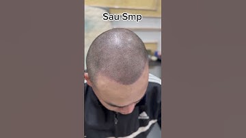 Một ngày làm việc tại tphcm của Tuấn Ori chuyên gia xăm tóc hói số 1 việt nam #scalp #xămtóc
