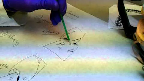 Dr. Martin on Fixing Occlusal Interference