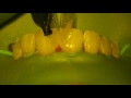 Closing Spaces Between Front Teeth - Bioclear Technique