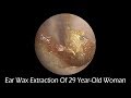 Both Side Of EarWax Removal Of 31 Year Old With Music