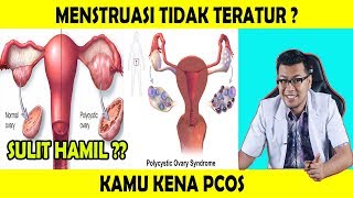 Menstruasi Tidak Teratur Mungkin Kamu PCOS - dr Saddam Ismail