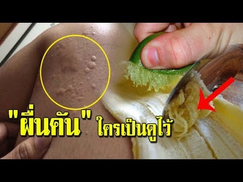 อาการ ผด"ผื่นคัน" รักษาได้ด้วยของใกล้ตัว ที่หลายคนมองข้าม! ด้วยวิธีง่ายๆ !!