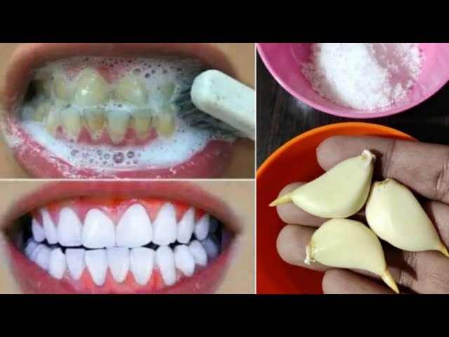 Teeth whitening at home in 2 minutes ||  How to naturally whiten your yellow teeth || 100% effective class=
