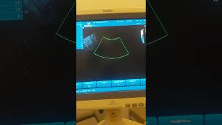 Cervical polypزائده لحميه بعنق  الرحم