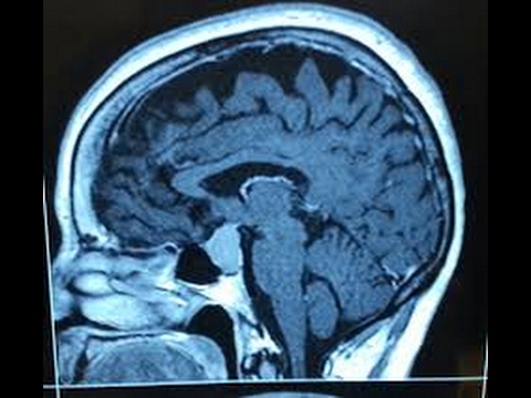 Video: Hipofizės Adenilato Ciklazę Aktyvinančio Polipeptido Pernešimas Per Hematoencefalinį Barjerą: Poveikis Migrenai