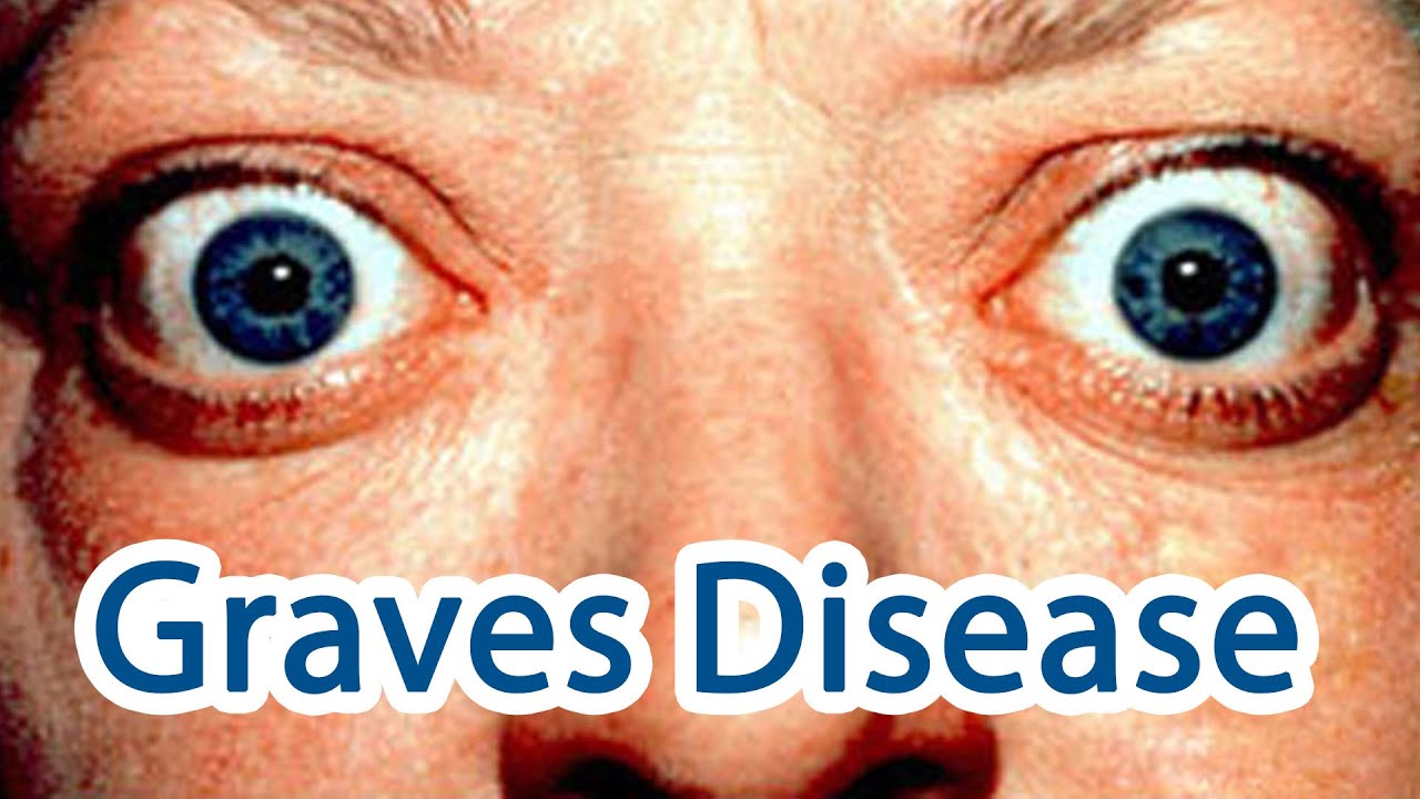 What is graves disease