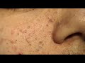 Blackheads Extractions on ¨D¨