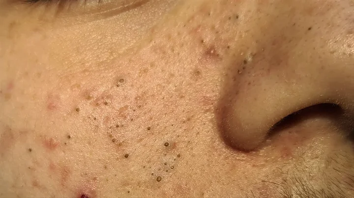 Blackheads Extractions on D