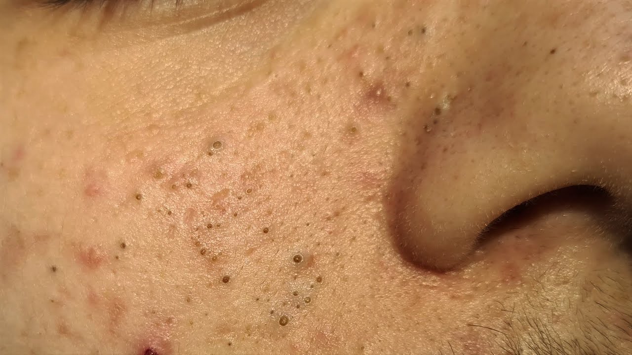 Blackheads Extractions on ¨D¨