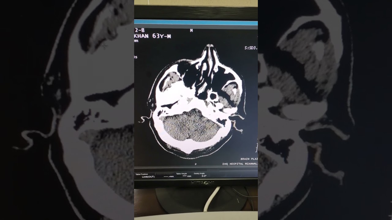 CT scan computer 🖥️ report ☺️      
