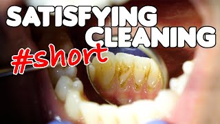 Satisfying Dental Cleaning #shorts