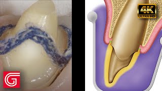 Soft Tissue Management and Impression Technique by Michael DiTolla, DDS, FAGD screenshot 2