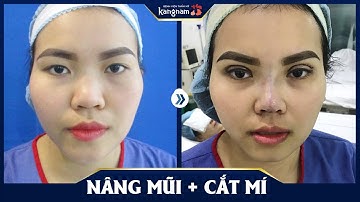 Nâng mũi và cắt mí mắt cùng lúc được không?