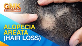 Managing alopecia areata o hair loss | Usapang Pangkalusugan