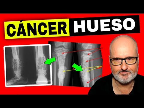 Video: Prognos för skelettcancer - osteosarkom, kondrosarkom, Ewings sarkom