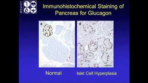 Hypoglycemia after gastric bypass an emerging complication