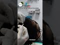 PRP ( PLATELET RICH PLASMA) HAIR TRANSPLANT, SKIN & HAIR TREATMENT #hairtransplant #skintreatment