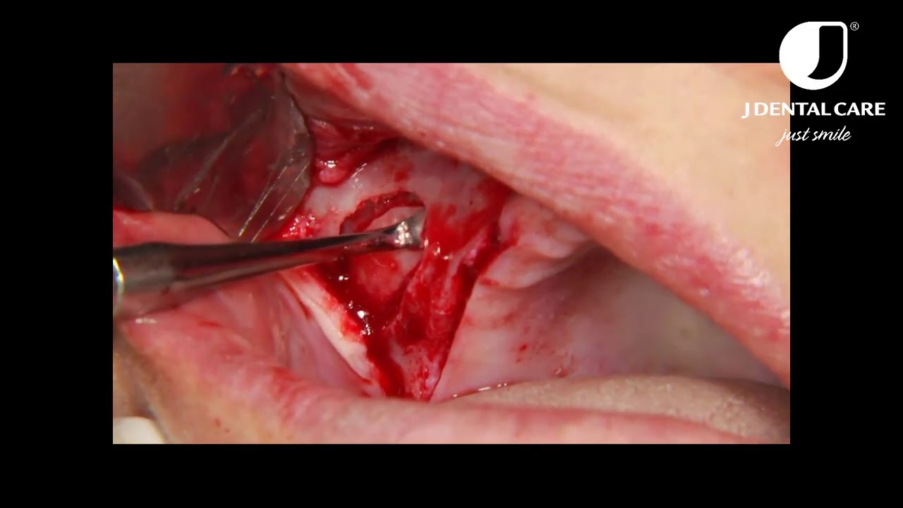 Lateral window sinus elevation technique - step by step video