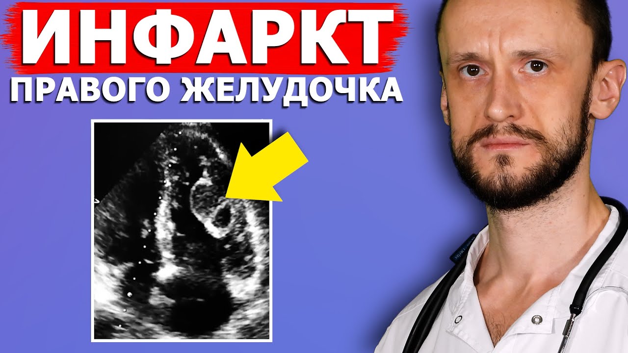 Инфаркт правого желудочка с тромбами | УЗИ сердца | ЭхоКГ для врачей | Обучение ОНЛАЙН
